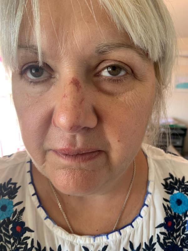 Whilst walking my dog at approximately 07.45 on Thursday 11th August, I tripped on the pavement outside number 102 Climping Road, the pavement is uneven and lumpy. My trainer caught the lump, i fell on my right hand and my face hit the tarmac. I do not have any recollection of how I got home, my face was bleeding and I was in shock.  I have abrasions to my face, a bruised tooth, a lump on my forehead and grazed knees. I have pulled my right side and my back. My daughter took me to the walk in centre at Crawley Hospital I was assessed, pain killers given, my hand was X-rayed, thankfully no broken bones but bad bruising and swelling. I am a support worker so my right hand is very much needed. I had two days off work recovering from the shock and trauma I experienced. My hand is still not good as I cannot grip. I would like compensation for the traumatic experience suffered. The pavement is terrible all around Climping Road, I am now terrified of walking around there.-104 Climping Road, Crawley, RH11 0AY